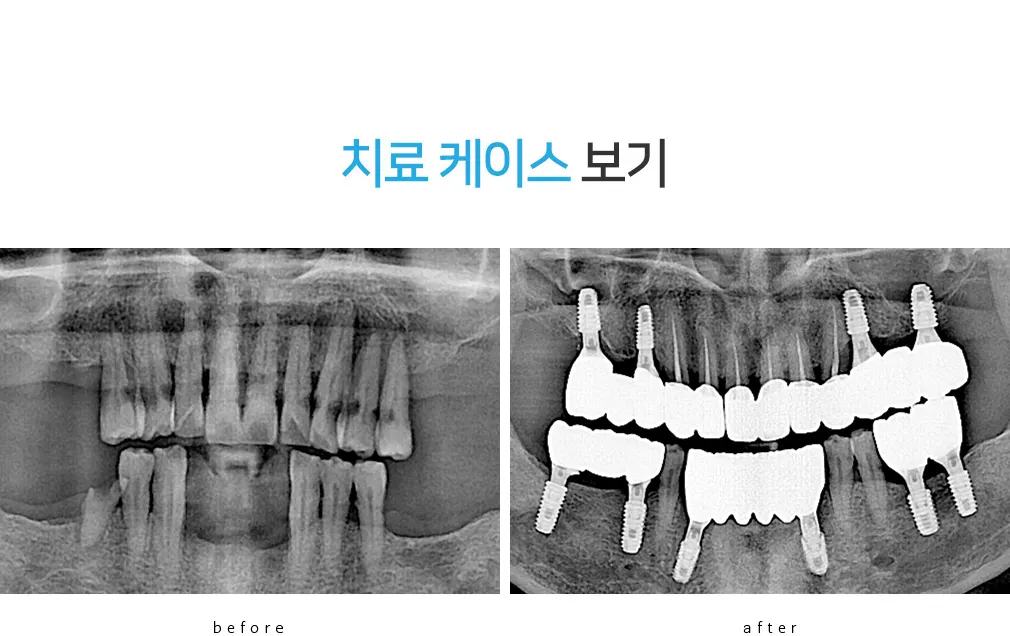 치료 전후를 비교한 파노라마 엑스레이 — 상실된 치열과 보철이 올라간 상태