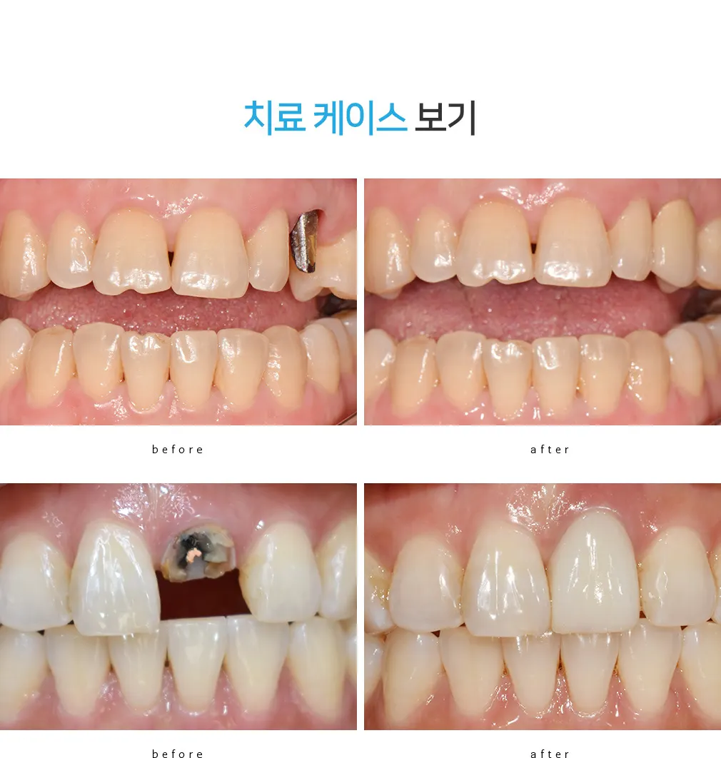 치료 전후를 비교한 구강 사진 두 쌍 — 아래쪽이 앞니 보철이다