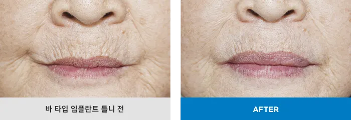 landing0 image section03 sl02 — 일등플란트치과의원